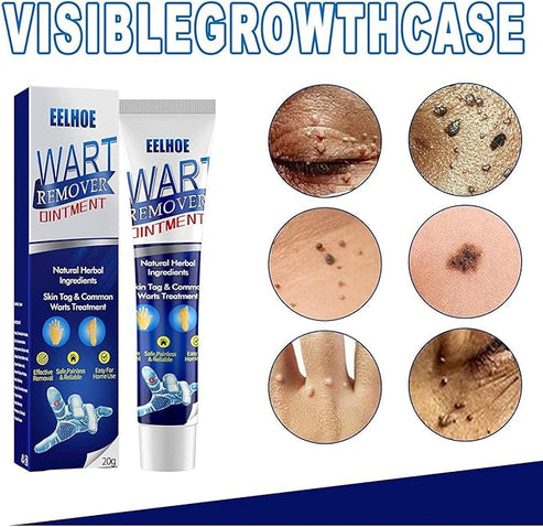 š„ Last Day Of Discount! Wart Remover Instant Blemish Removal Cream šāØ