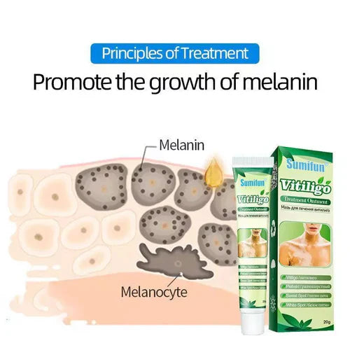 LAST DAY OF DISCOUNT ✨ Sumifun Vitiligo Treatment Cream 🌿