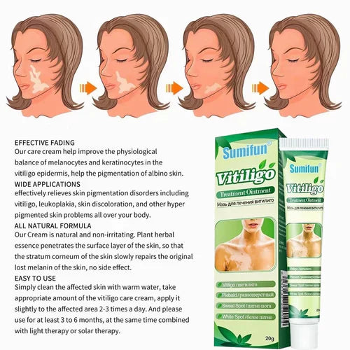 LAST DAY OF DISCOUNT ✨ Sumifun Vitiligo Treatment Cream 🌿