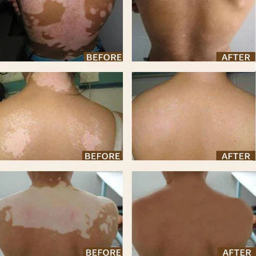 LAST DAY OF DISCOUNT ✨ Sumifun Vitiligo Treatment Cream 🌿